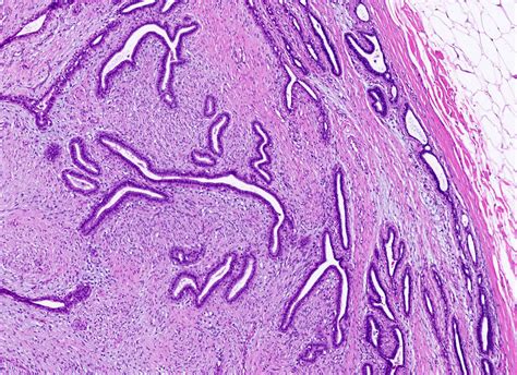 Pathology Outlines Fibroadenoma