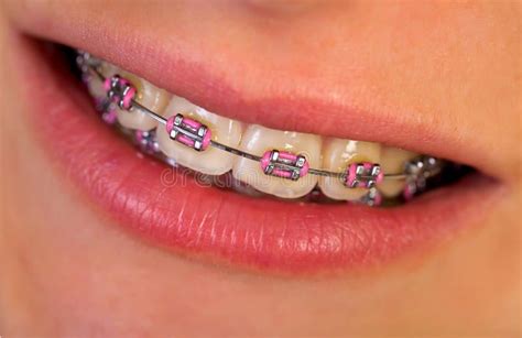 pink braces close up of a beautiful pink braces affiliate braces pink close pink