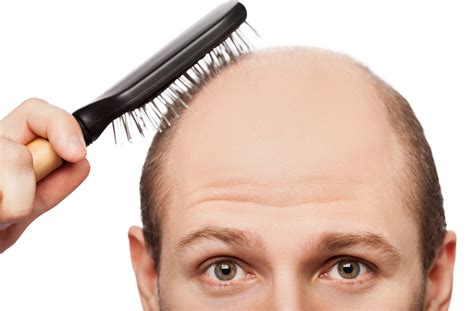 Going Bald Here S What You Need To Know About Hair Loss