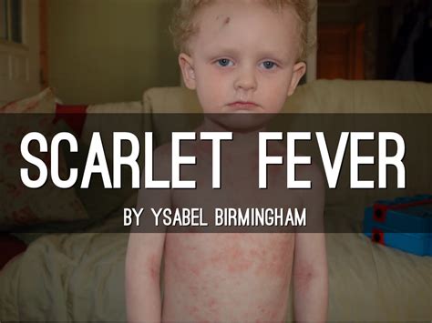 Copy Of Scarlet Fever By Ysabel Birmingham