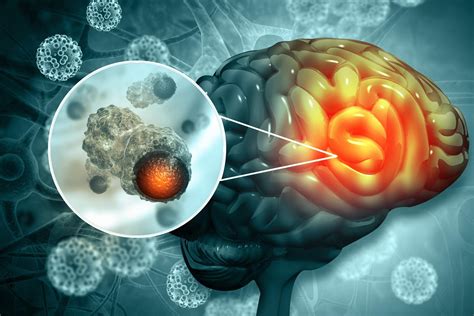Tipuri De Tumori Cerebrale Cauze Si Simptome Neuroaxis Hot Sex Picture