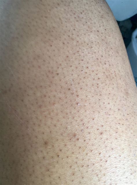 Skin Concerns My Poor Thighs They Always Feellook Like A Big