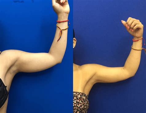 Before After Arms Liposuction Neinstein Plastic Surgery