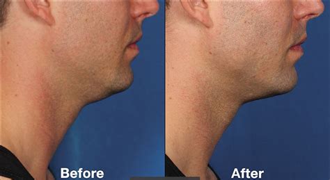 Before And After Pictures Of Kybella™ In Charlotte Nc Darst