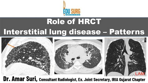 Hrct Chest In Interstitial Lung Disease Chest Radiography Basics
