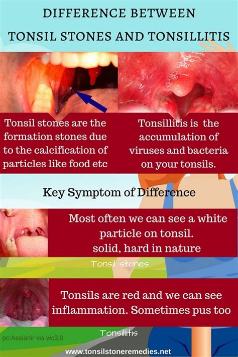 Key Difference Between Tonsil Stones And Tonsillitisdont Get Confused
