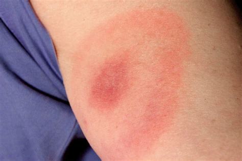 Lyme Disease Symptoms What You Need To Know Shooting Uk