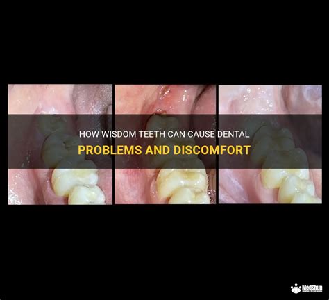 How Wisdom Teeth Can Cause Dental Problems And Discomfort Medshun