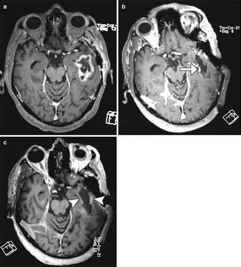 Imaging The Intraoperative And Postoperative Brain Radiology Key