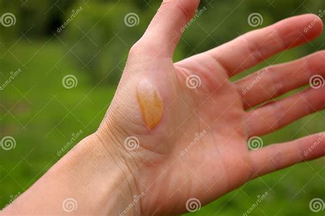 Human Hand With A Burn Blister Manand X27s Hand With A Fluid Filled