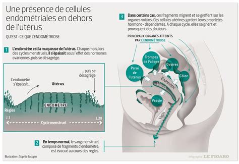 Règles Et Rapports Sexuels Douloureux Et Si Cétait Lendométriose