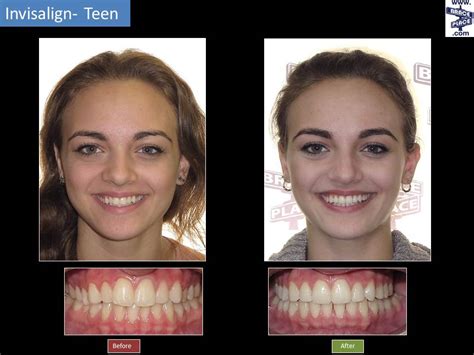 Before And After Photo With Invisalign Treatment Braces Invisalign My
