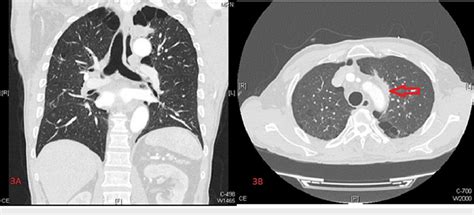 Chest Computed Tomography With Iodine Contrast Coronal And Axial
