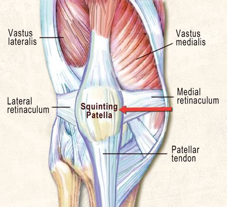 A retinaculum refers to any region on the body in which tendon groups from. Squinting Patella, MPDs & Runner's Knee - Erik Dalton Blog