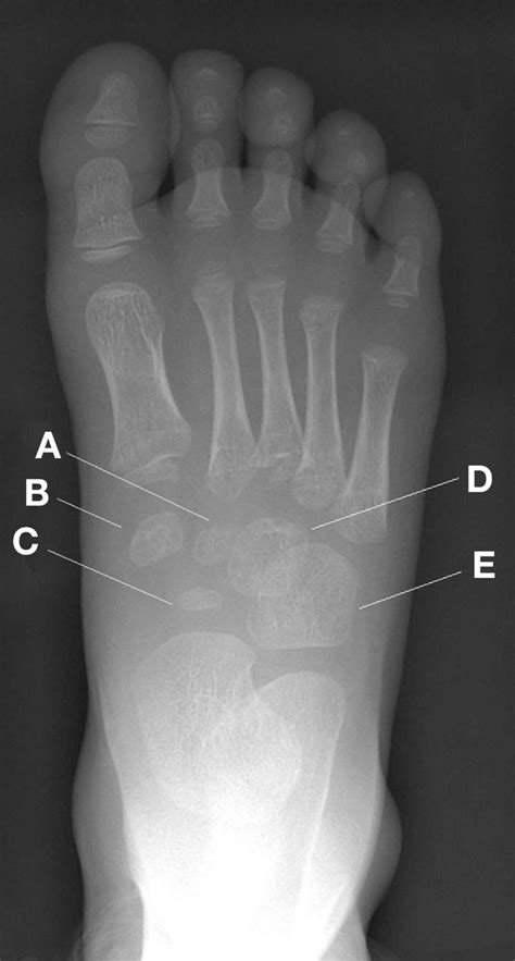 Radiograph of a 3 year old child's right foot | The BMJ