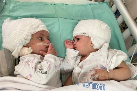 Conjoined Twins Separated Successfully Photos