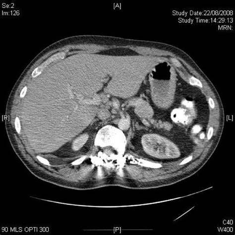 Axial Ct Of Upper Abdomen Demonstrates Mildly Enlarged Para Aortic And