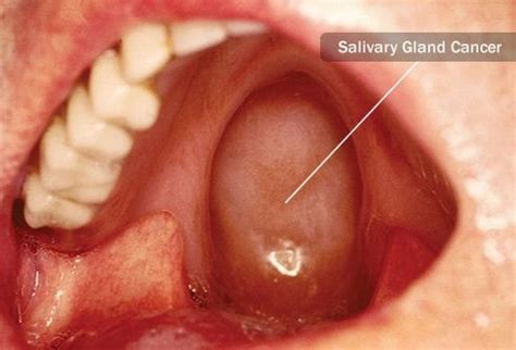 The feeling is called 'globus hystericus' and is common when you have a tumor in the larynx. Throat Cancer Photos Early Stages - Cancer News Update