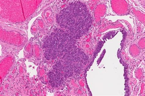 Ovary And Fallopian Tube Atlas Of Pathology