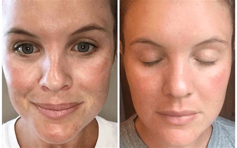 microneedling before and after - Estetika Clinic