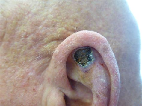 Squamous Cell Carcinoma Ear Pictures The Meta Pictures
