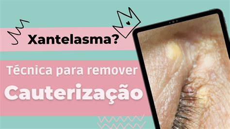 Esteticista Pode Remover Xantelasma