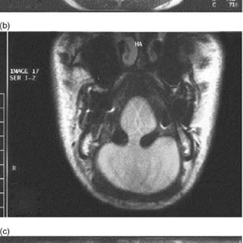 Pdf Giant Sublingual Epidermoid Cyst A Report Of Two Cases