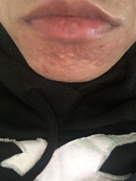 Skin Colored Bumps On Chin Treatment Hypertrophic Raised Scars