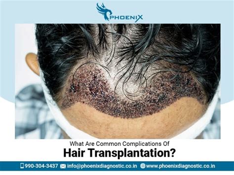 What Are Common Complications Of Hair Transplantation