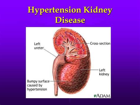 Hsu c.y., iribarren c., mcculloch c.e., darbinian j., go a.s. PPT - Chronic Kidney Disease What You Need to Know ...