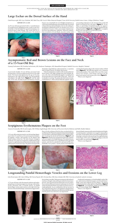 Large Eschar On The Dorsal Surface Of The Hand—quiz Case Allergy And