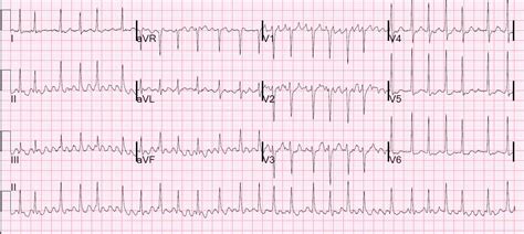 Dr Smiths Ecg Blog What Is The Rhythm Answer At The Bottom