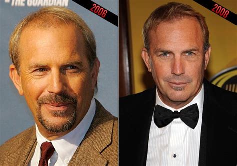 Kevin Costner Hair Transplant Or Natural