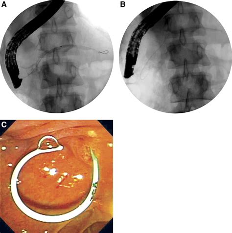 Pancreatic Stents For Prevention Of Postendoscopic Retrograde Cholangiopancreatography