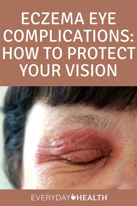 Eczema Eye Complications How To Protect Your Vision Everyday Health