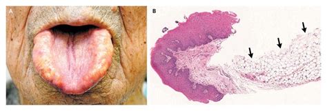 Lipomatosis Of The Tongue Nejm