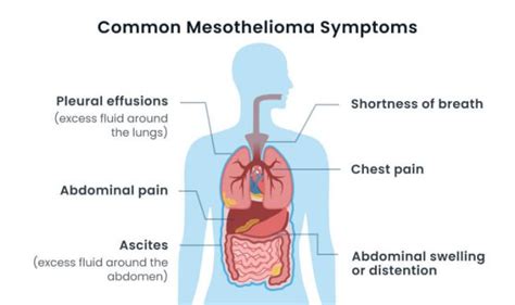 Malignant mesothelioma is a disease in which malignant (cancer) cells form in the lining of the chest or abdomen. Mesothelioma Cancer Symptoms & Early Warning Signs