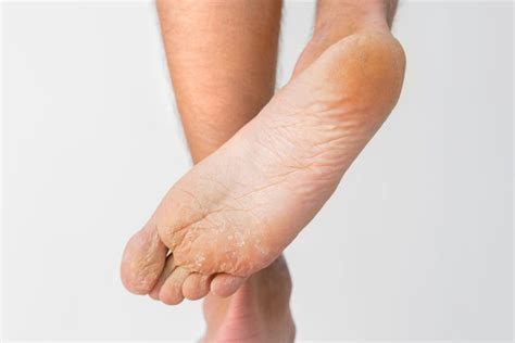 10 Subtle Signs Of Disease Your Feet Can Reveal Readers Digest