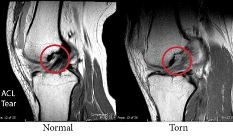 What Does A Torn Acl Look Like On Mri Dorian Whiteheads English