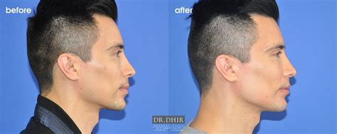 Facial Implants Dr Dhir