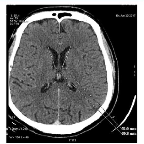 Ct Axial Image Of The Brain Showing The Length Of Body Of The Lateral