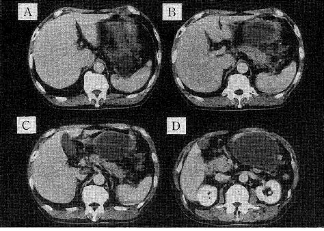 Figure 1 From A Rare Case Of Severe Acute Pancreatitis Complicated With