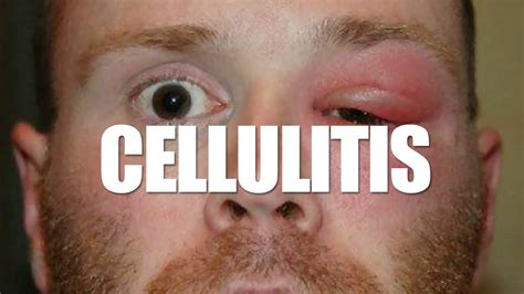 Cellulitis What Is Cellulitis Youtube