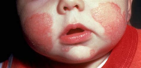 Eczema Bebe Pediatra Virtual