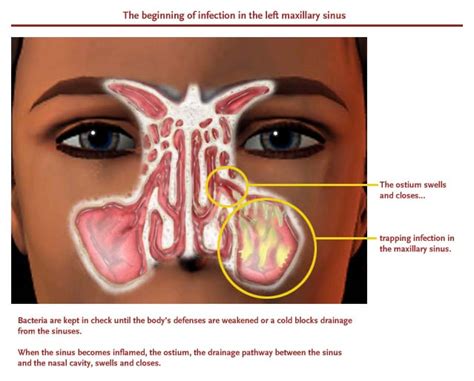 Sinus Infection Symptoms Can Your Toothache Be A Sinus Infection