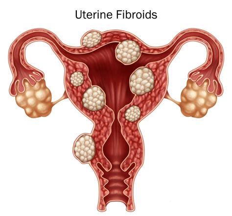 Is Ufe A Fibroid Treatment Option If I Have Endometriosis Fibroid Institute Dallas