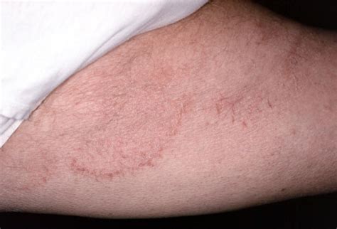 Picture Of Ringworm Of The Groin Tinea Cruris