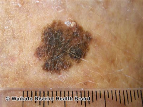 Malignant Melanoma Of The Skin Skin Cancer Geeky Medics