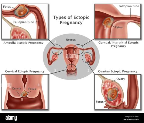 Illustration Of Common Ectopic Pregnancies Pregnancies Occurring In Stock Photo Royalty Free