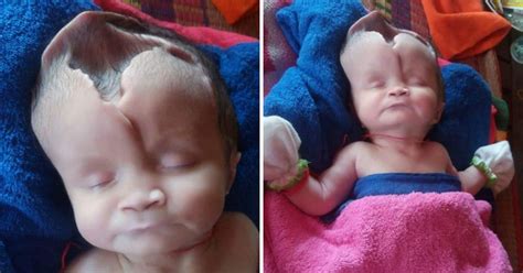 बिना सिर और दिमाग के पैदा हुई ये बच्ची देखिए तस्वीरें This Child